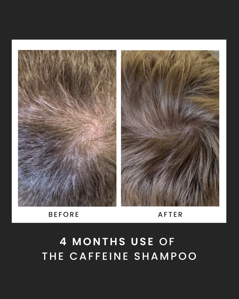 Caffeine hair loss 2025